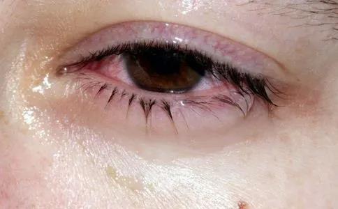 眼睛發(fā)癢難忍，竟是因?yàn)樗?></a></dt>
        <dd>
          <h2><a href=